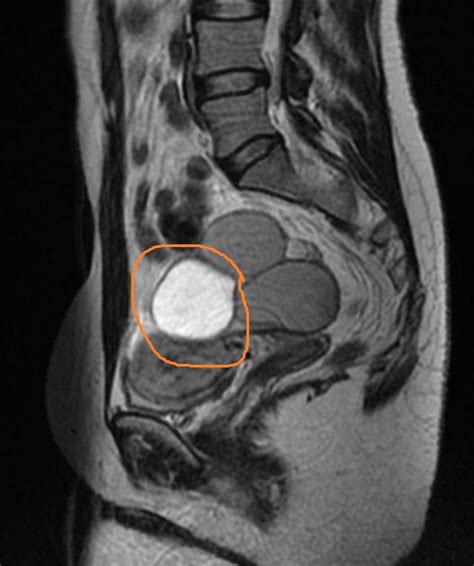 endometriosis mri images